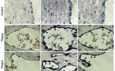 RNA editing controls atherosclerosis